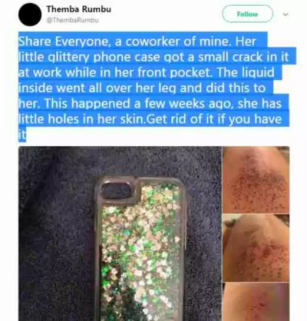 Glittery Phone Case Leaves Injury On South African Lady